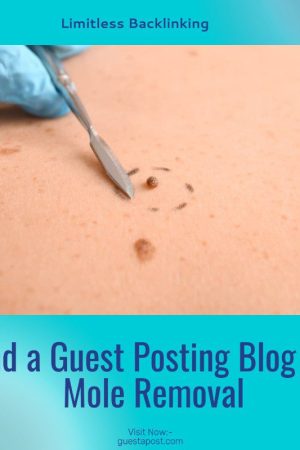 Find a Guest Posting Blog on Mole Removal